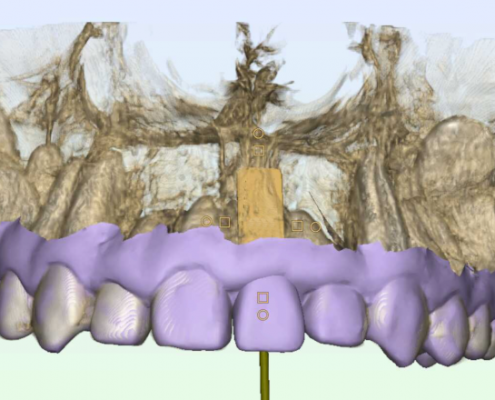 Implantologia dinamica 3D