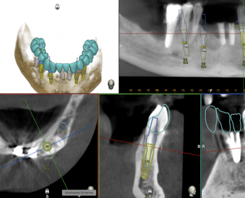 Implantologia dinamica 3D con Navident