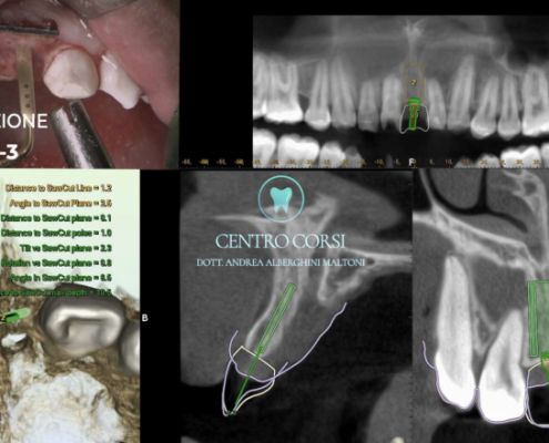 Implantologia dinamica 3D con Navident