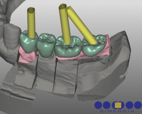 Progettazione protesi con software CAD