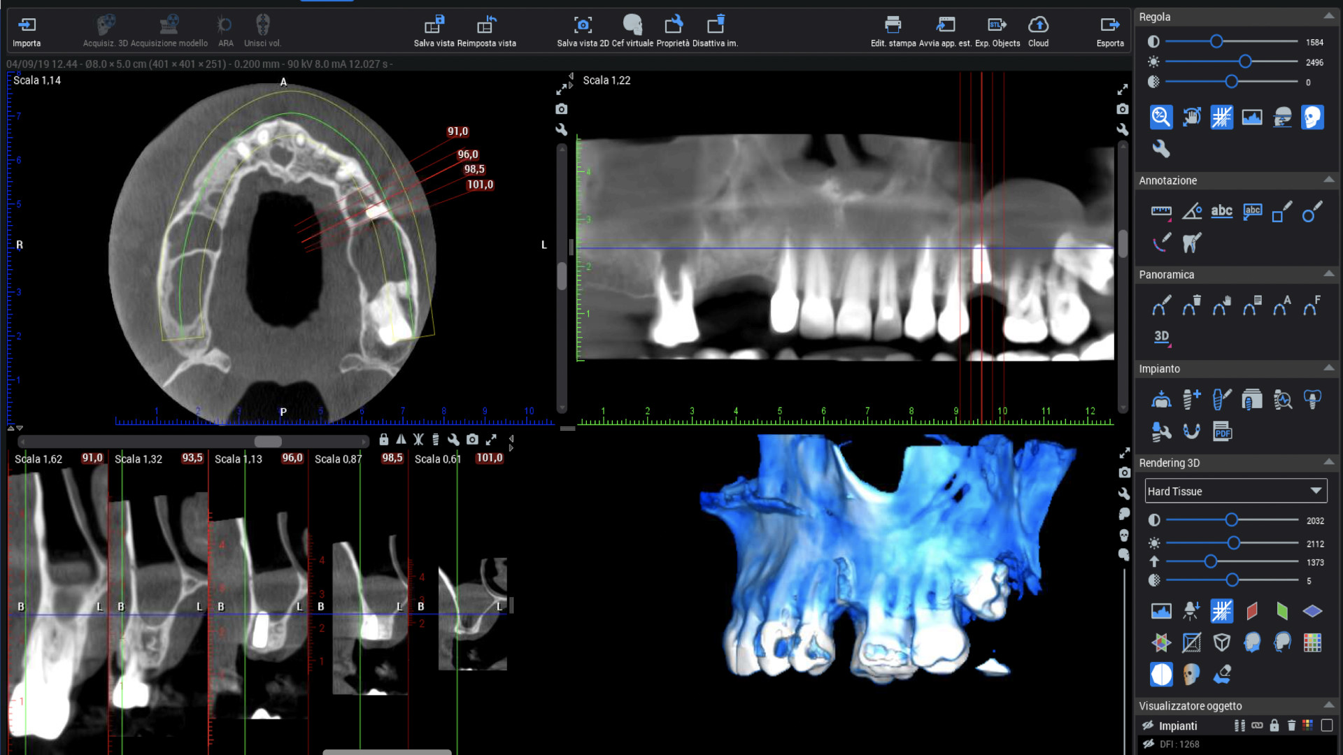 Radiologia Cone Beam tridimensionale ad alta risoluzione